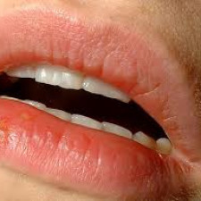 Opar poznáte podle puchýřků