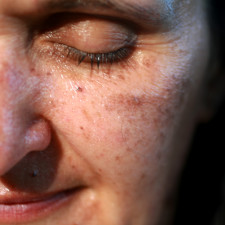 Pigmentových skvrn se můžete zbavit poměrně lehce, pomůže vám s tím mimo jiné i pravidelný peeling