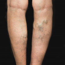 Riziko vzniku křečových žil může zvyšovat mimo jiné i konzumace slazených nápojů