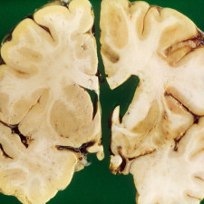 Huntingtonova choroba