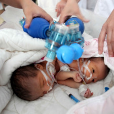 Abby a Brittany Hensel neměly přežít ani první noc, nakonec mají dva vysokoškolské tituly