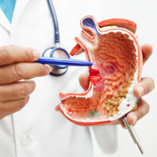 Rakovina tlustého střeva a konečníku může vzniknout, když se buňky střevní sliznice začnou nekontrolovaně dělit